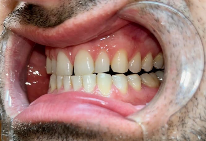 Ukázka mých zubů před rovnáním