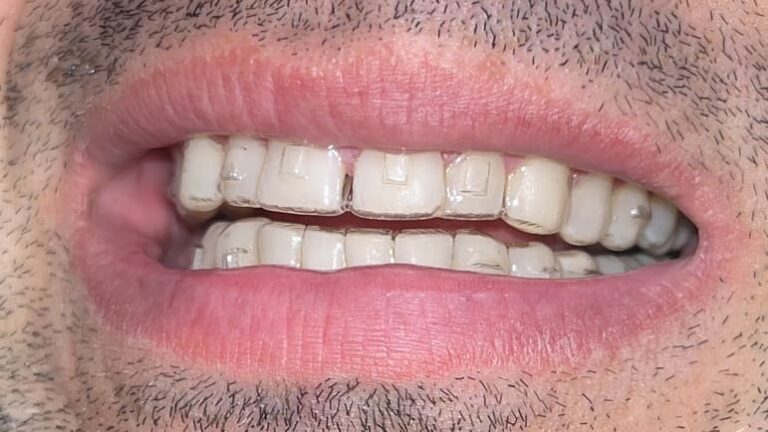 Alignery nasazení na zuby