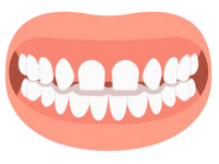 mezery mezi zuby