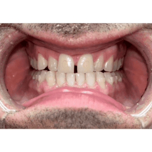 Progres rovnání zubů - 1.týden