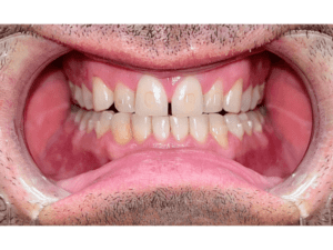 Zuby po 3 měsících s neviditelnými rovnátky - zpředu