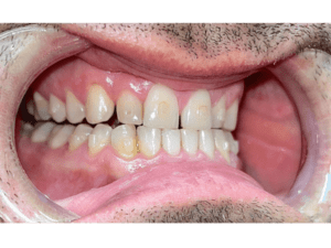 Zuby po 3 měsících s neviditelnými rovnátky - pravá strana