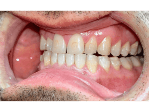 Zuby po 3 měsících s neviditelnými rovnátky - levá strana